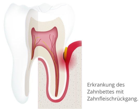 paro erkrankung zahnbett