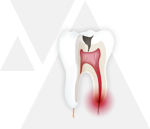 endodontie step 1